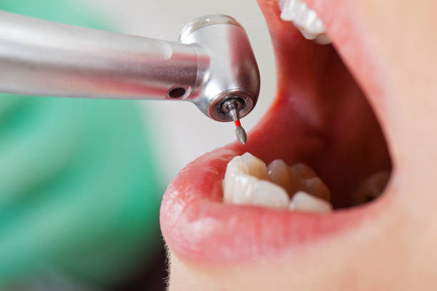 Best Emergency Dentist for Lost Fillings or Crowns in Andrews, SC